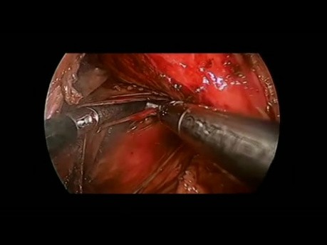 Toupet laparoskopische unvollständige hintere Fundoplikatio