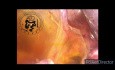 Laparoskopische Erkundung des gemeinsamen Gallengangs und intraoperative Choledochoskopie