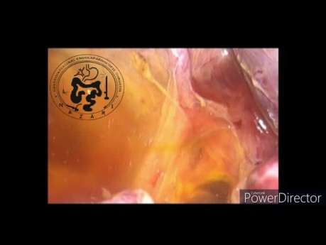 Laparoskopische Erkundung des gemeinsamen Gallengangs und intraoperative Choledochoskopie
