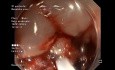 Große Läsion mit gemischter LST-G-Morphologie, behandelt mit Mukosektomie (pEMR)