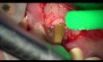 Ästhetische Implantation mit dem YSGG-Laser