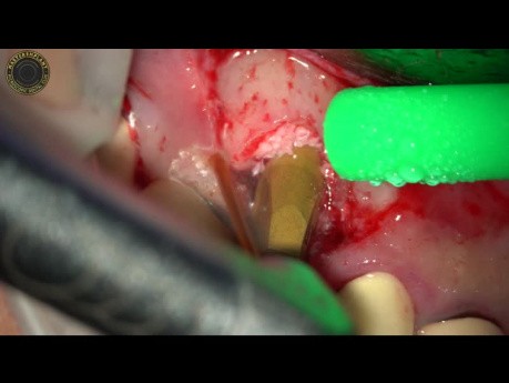 Ästhetische Implantation mit dem YSGG-Laser