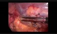 Blutung von ITP (Immunthrombozytopenie)