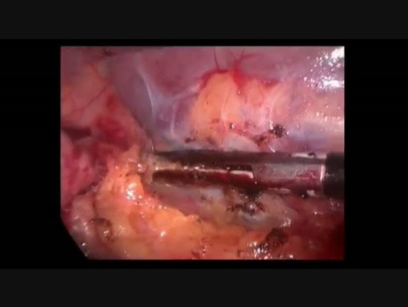 Blutung von ITP (Immunthrombozytopenie)