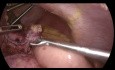 Laparoskopische Umwandlung einer Schlauchgastrektomie in einen gastrointestinalen Ausschluss mit Roux-en-Y-Schleife und Reparatur einer Hiatushernie der Speiseröhre