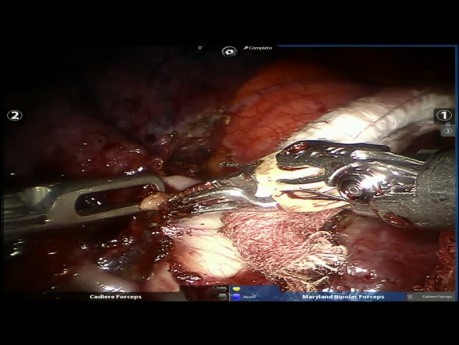 Roboterassistierte Lobektomie des linken Lungenoberlappens