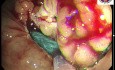 Endoskopische Resektion eines Tumors, der sich im Bereich des rechten Dickdarms ausbreitet