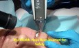 Hauterneuerung durch CO2-Laserfraktionierung