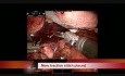 Entfernung des Leiomyoms aus distale Strecke des Ösephagus. Die Roboterassistierte Prozedur durch Bauch.