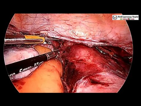 Totale laparoskopische Hysterektomie- Uterus myomatosus