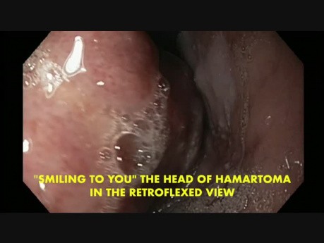 Ein riesengroßer gemischter  mesenchymaler Tumor - Hamartoma der Speiseröhre