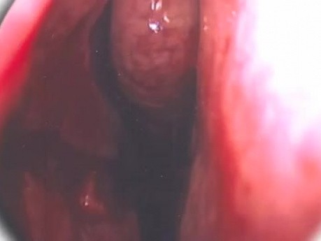 Septumplastik - Endoskopie - Aktualisiert