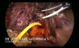Laparoskopische Platzierung der T-Drainage bei Mirizzi-Syndrom Typ IV