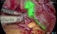 Laparoskopische Adenomyomektomie unter NIR-ICG-Bildgebung