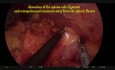 Laparoskopische intersphinkterische Resektion mit ableitendem Ileostoma