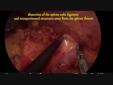 Laparoskopische intersphinkterische Resektion mit ableitendem Ileostoma