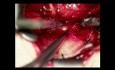 Intradural gelegenes Fremdmaterial