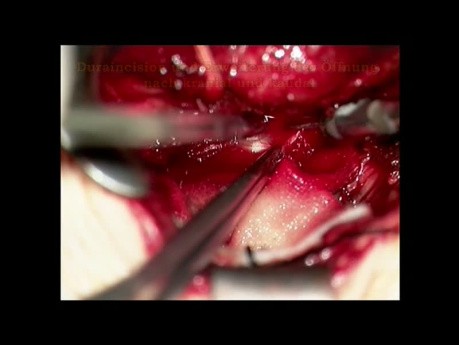 Intradural gelegenes Fremdmaterial