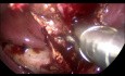 Laparoskopische Behandlung der akuten Cholezystitis im Verlauf einer Cholelithiasis