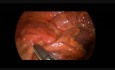 Der Einsatz der Staplertechnik bei der laparoskopischen Segmentresektion des Dickdarms