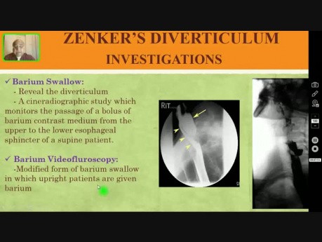 Zenker-Divertikel - Dysphagie