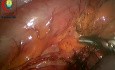 Laparoskopische Sigmoidektomie bei Volvulus