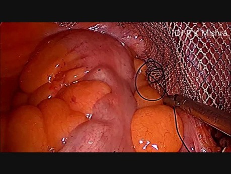 Laparoskopische IPOM-Reparatur von Leistenbruch