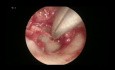 Endoskopische PORP-Tympanoplastik bei chronischer Otitis media