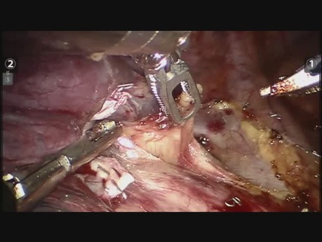 Roboterassistierte Chirurgie - Lobektomie Oberlappen rechts