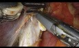Roboterresektion eines Klatskin-Tumors vom Typ IIIB