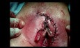 Krebs der Vulva - Exzision und Doppeltransplantation