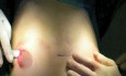 Reparatur von Pectus Carinatum bei Kindern