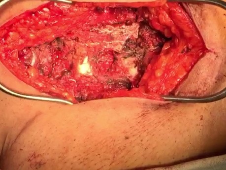 Patient mit penetrierender Sternum-Frakturtur und Herzschädigung