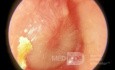 Akute Otitis media