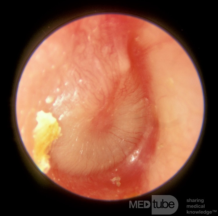 Akute Otitis media