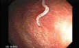 Der Peitschenwurm - der Wurm im Dickdarm