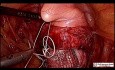 Laparoskopische Sakrokolpopexie bei der Patientin mit dem Vorfall des Scheidengewölbes