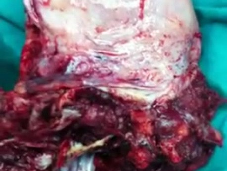 Plazenta praevia, die in das untere Uterussegment eindringt - chirurgische Behandlung der parösen Frau