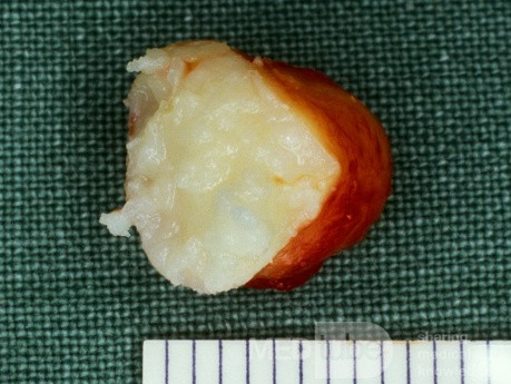 Epidermalzyste (Gewebeprobe)