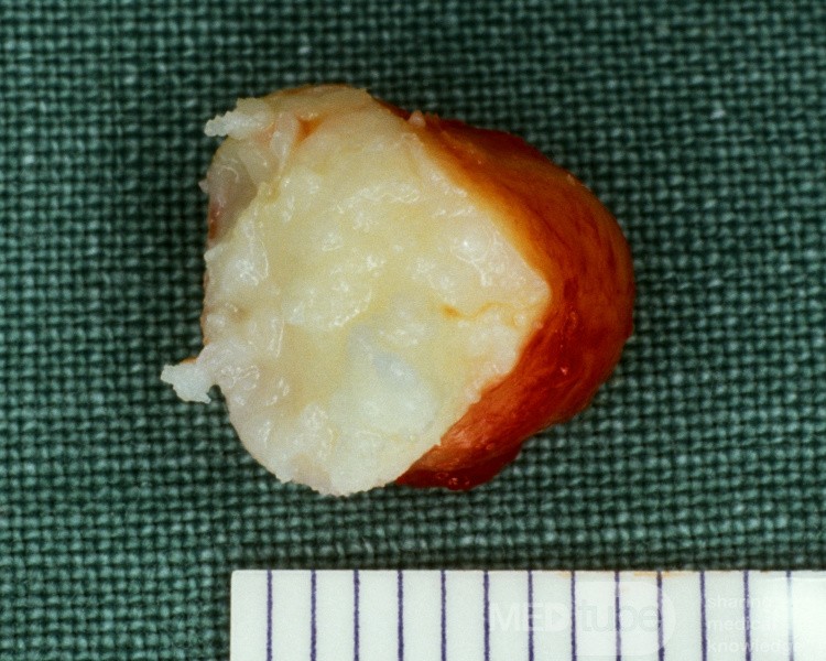 Epidermalzyste (Gewebeprobe)