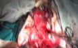 Radikale Chirurgie der Gebärmutter - Dissektion des Ureterkanals