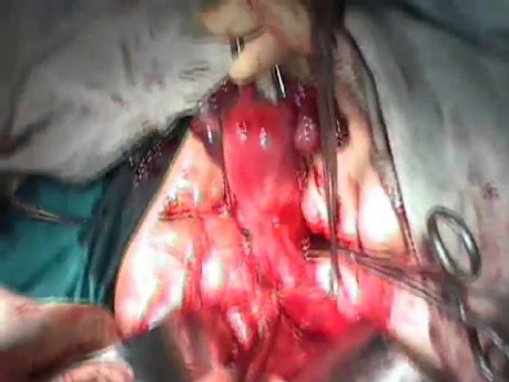 Radikale Chirurgie der Gebärmutter - Dissektion des Ureterkanals