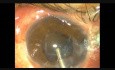 Choroidale Blutung beim Nanophthalmus