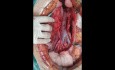 Anatomische Variation der großen Gefäße