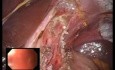 Laparo-endoskopische Single Site (LESS) Myotomie nach Heller und vordere Fundoplikatio