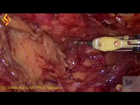 Niedrige anteriore laparoskopische Rektumresektion bei Rektumkarzinom