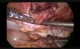 Laparoskopische Reparatur der Spigelschen Hernie