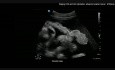 Staging des Ovarialkarzinom mittels Ultraschall + chirurgische Videos
