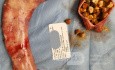 Schlauchmagen- und Cholezystektomie-Effekt - ein Teil der Magen- und Gallenablagerungen entfernt