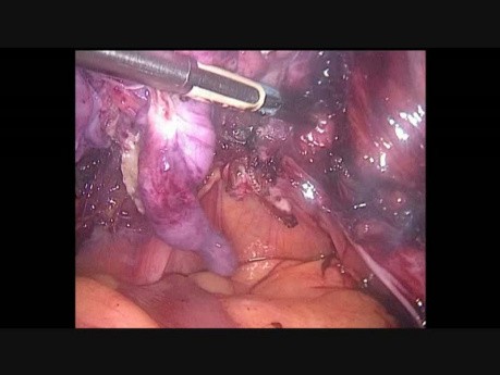 Totale laparoskopische Hysterektomie und bilaterale Salpingo-Oophorektomie